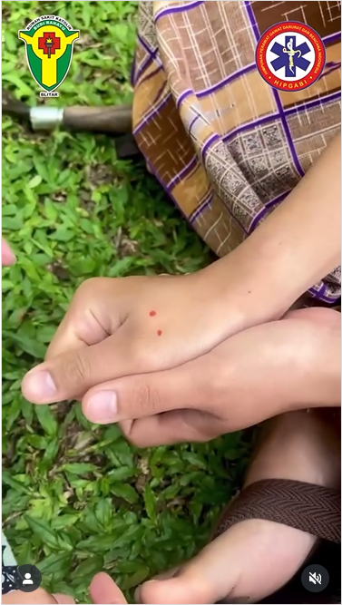 Panduan Pertolongan Pertama yang Tepat saat Digigit Ular